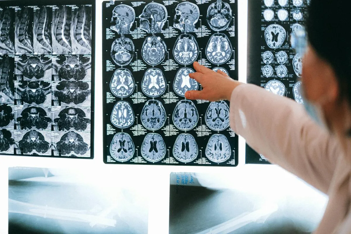 El dispositivo utiliza microelectrodos implantados en la corteza motora para captar señales neuronales. Foto: Pexels