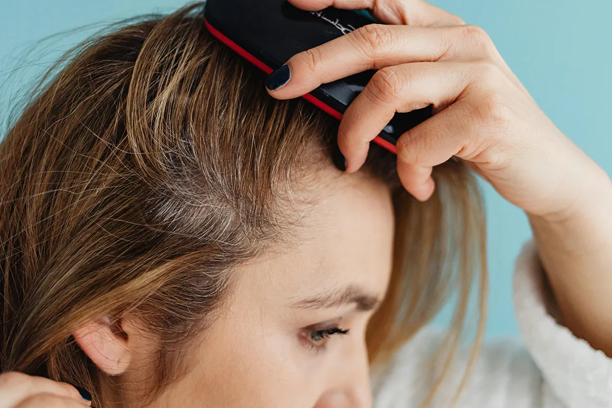 El estrés crónico puede desencadenar efluvio telógeno y alopecia areata