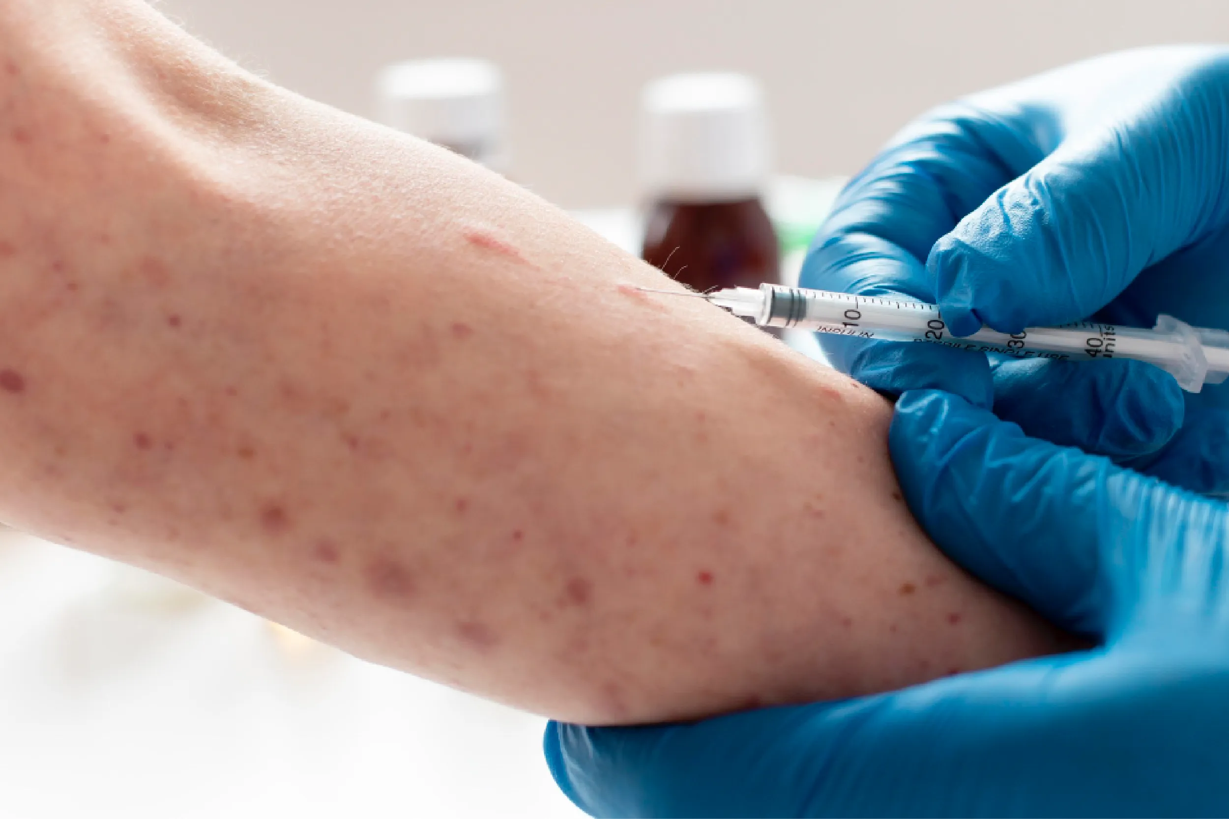 Activan alerta sanitaria por sarampión en dos alcaldías de la capital.